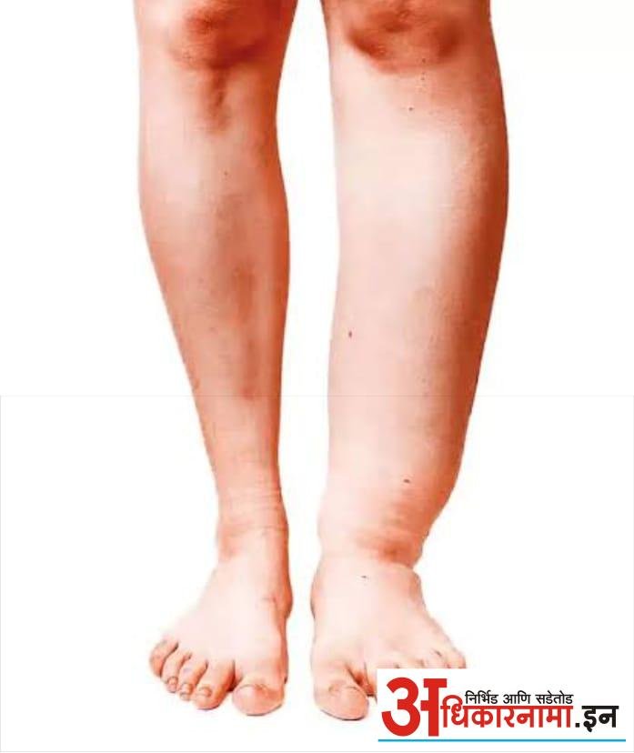 नवापुर तालुक्यात हत्तीरोग नियंत्रणासाठी सामुदायिक औषधोपचार मोहिम सुरु - अपर्णा पाटील